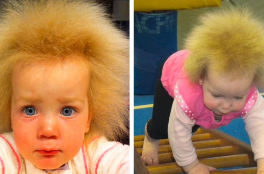  Dandelion-Girl With “Uncombable Hair Syndrome”: What Does a 10-Year-Old Girl Look Like Now?