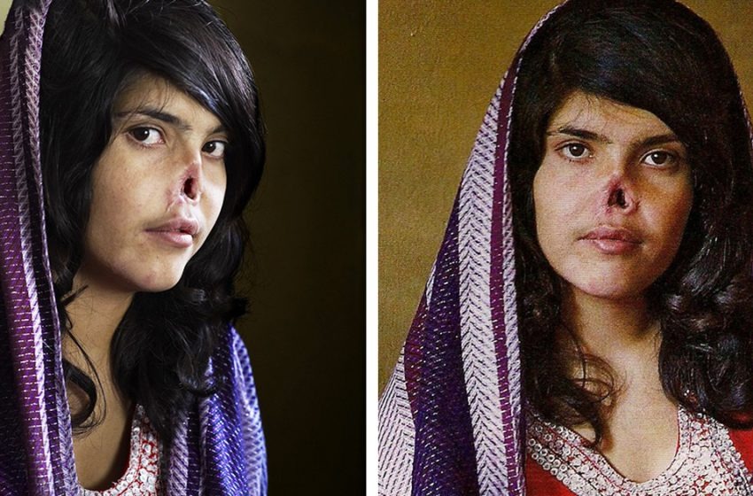  “At 14, Left Without a Nose and Ears at The Mercy of Her Husband”: What a Woman Looks Like Now