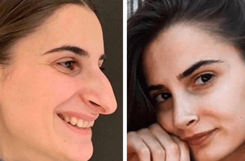  Photos of ordinary girls who look better after rhinoplasty