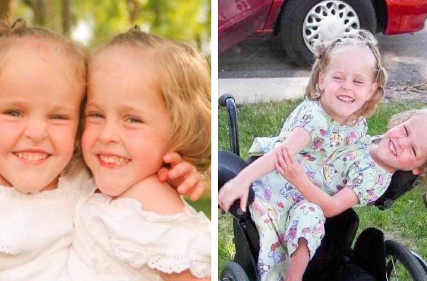  Bu Siyam ikizleri 4 yaşındayken ayrıldı: Şimdi durumları nasıl