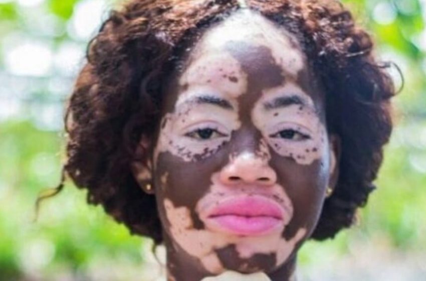  “İnsanlar Onun Asitle Yakıldığını Düşündü”: Dünyayı Kazanan Vitiligo’lu Benzersiz Bir Kız Tam Boy Fotoğraflarını Paylaştı!