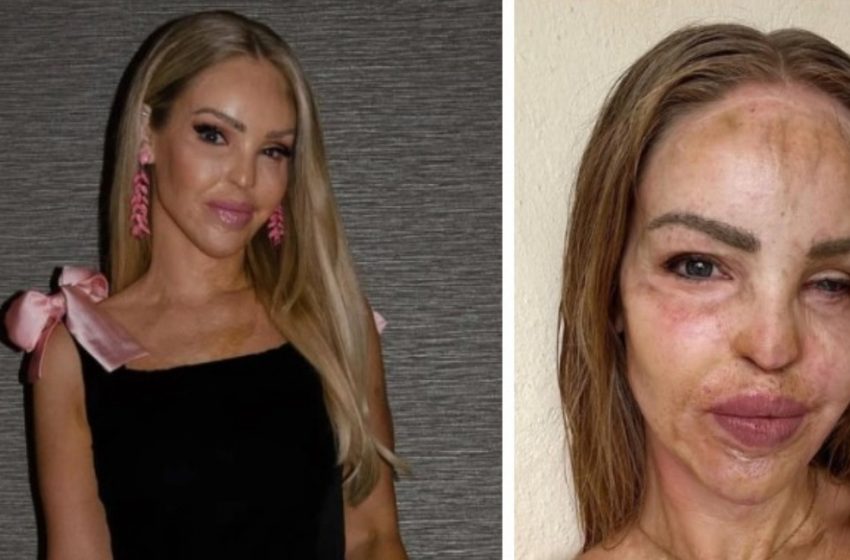  Katie Piper împărtășește o actualizare inspirațională la 16 ani după ce a supraviețuit atacului cu acid: Detalii neprevăzute!