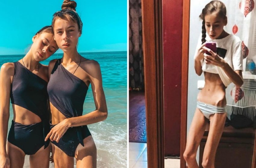  Au cântărit doar 83 lbs și au fost aproape de moarte, dar au reușit să învingă! Cum arată acum?