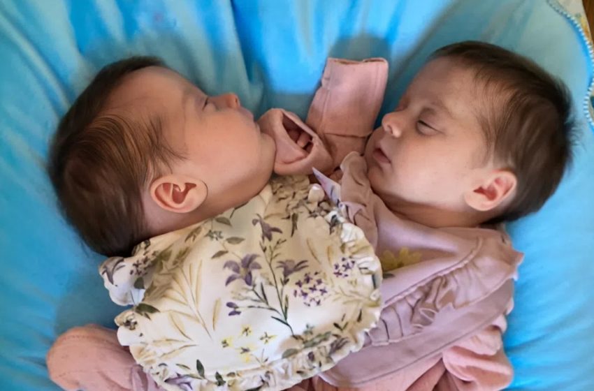  Rinnast ühendatud kaksikute teekond: kolm aastat pärast lahutamist õitsevad nad nüüd — vaata nende fotosid