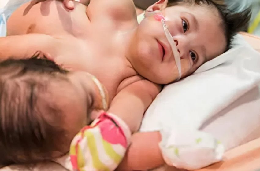  Povestea incredibilă a gemenelor siameze care au învins toate obstacolele!: Cum arată acum?