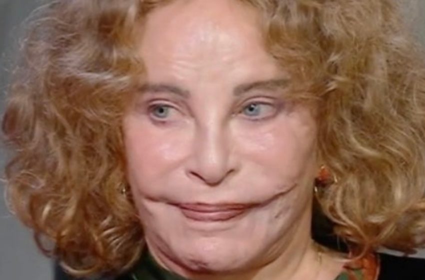  A fost odată numită cea mai frumoasă femeie din lume: dar un accident tragic i-a desfigurat fața!