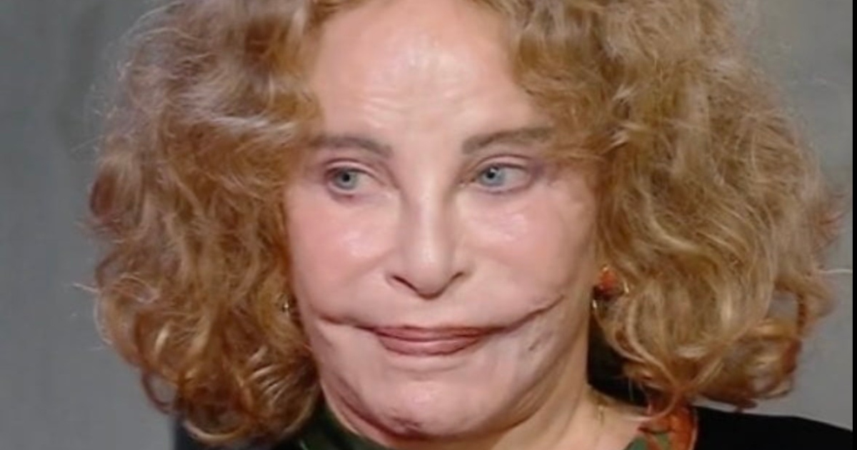 A fost odată numită cea mai frumoasă femeie din lume: dar un accident tragic i-a desfigurat fața!